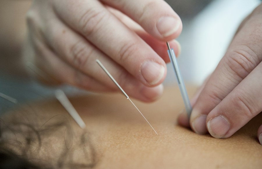 Japanse acupunctuurnaaldjes tijdens een behandeling